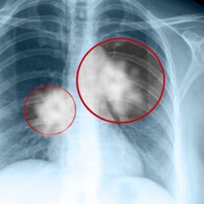 ung thư phổi - không nên chủ quan